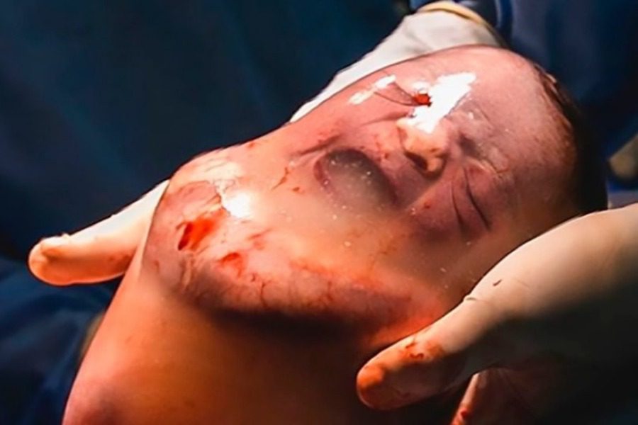 Φωτογραφίες σοκ: Μωρό γεννήθηκε μέσα στον αμνιακό σάκο