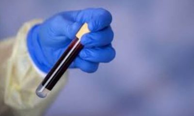 Τι λένε οι έρευνες σχετικά με την ομάδα αίματος και τον κορονοϊό 22