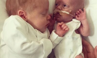 Η απίστευτη ιστορία μωρού που η αγκαλιά του δίδυμου αδελφού το βοηθά να επιβιώσει 17