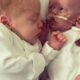 Η απίστευτη ιστορία μωρού που η αγκαλιά του δίδυμου αδελφού το βοηθά να επιβιώσει 18