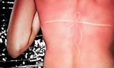 9 οδηγίες αντιμετώπισης για την ανακούφιση του δέρματος από το Ηλιακό έγκαυμα 14
