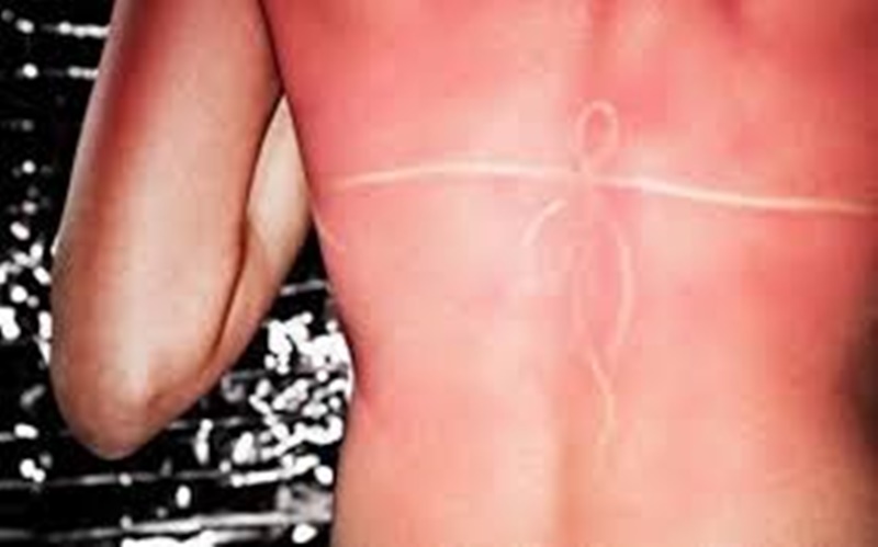 9 οδηγίες αντιμετώπισης για την ανακούφιση του δέρματος από το Ηλιακό έγκαυμα 1