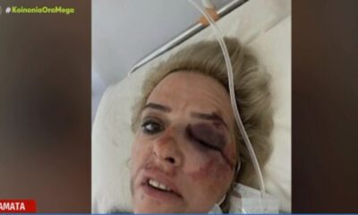 καλαμάτα: άλλη μια γυναίκα σώθηκε «από θαύμα» όταν της επιτέθηκε άγρια αγέλη σκύλων 30