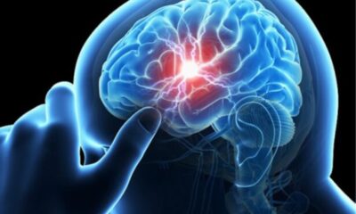 Δραματική αύξηση των θανάτων από εγκεφαλικά επεισόδια -Τι αναφέρουν οι επιστήμονες 1